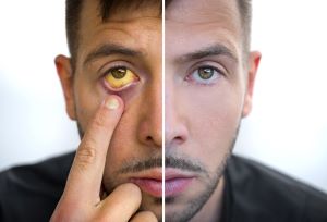 image of man with jaundice